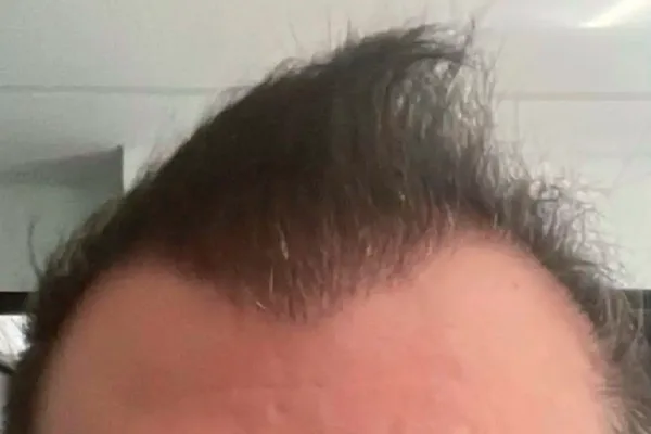 Implante capilar frontal — depois