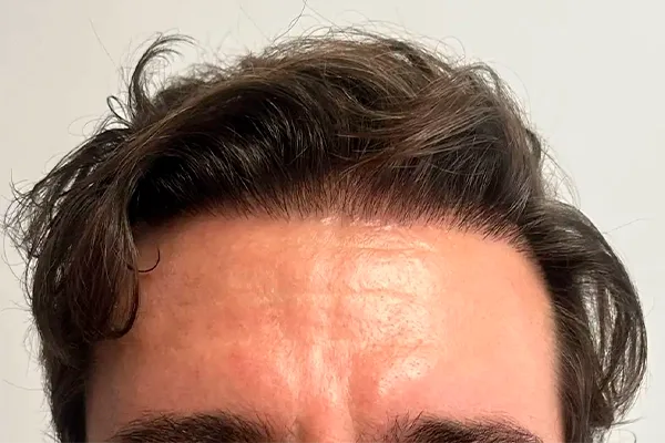 Restauração da linha frontal — depois