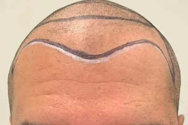 Implante capilar frontal — antes