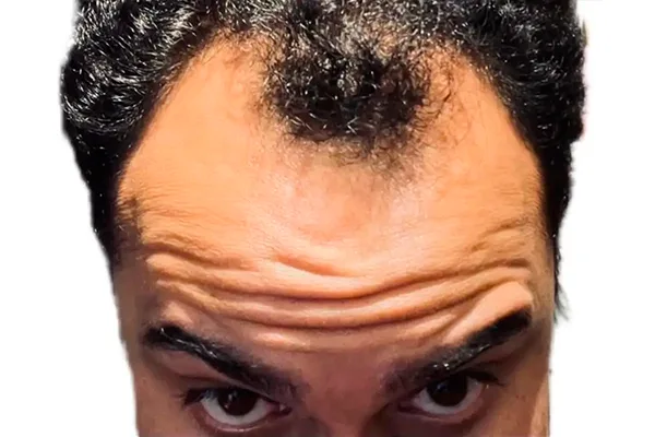 Recuperação da linha frontal — antes