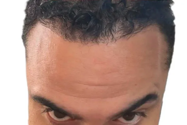 Recuperação da linha frontal — depois