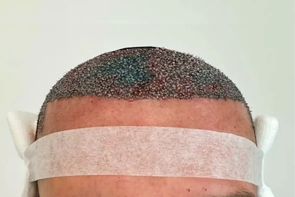 Restauração da linha frontal — antes